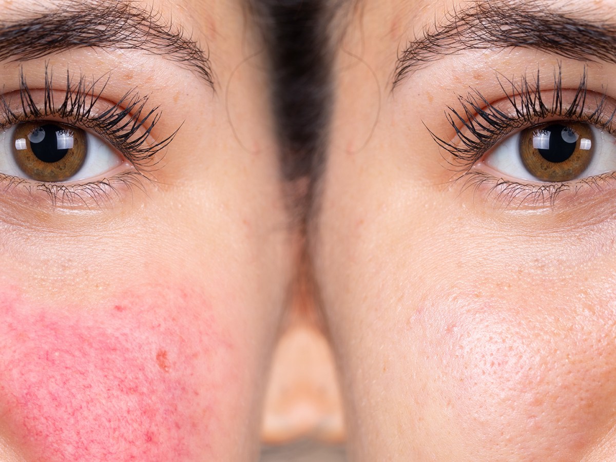 Redness & Rosacea