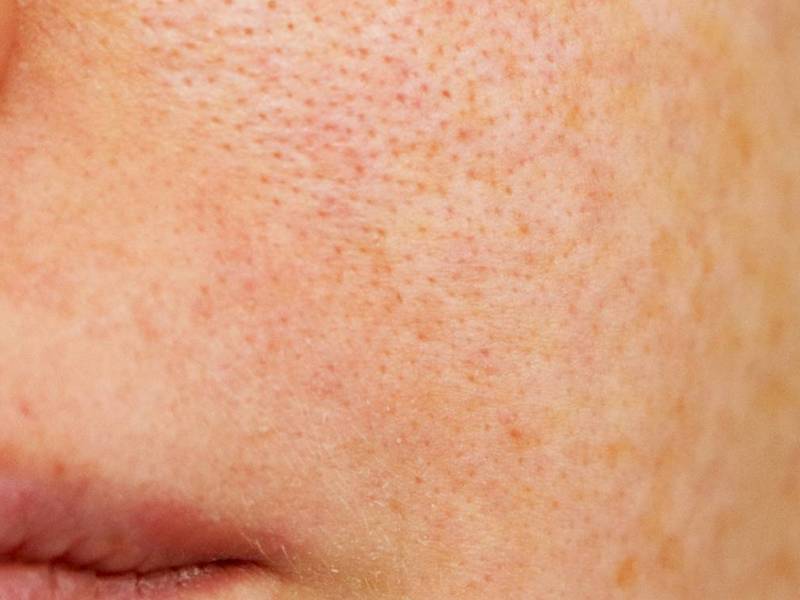 How Gut Health and Skin Health Go&nbsp;Together